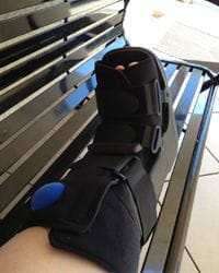 cast broken foot